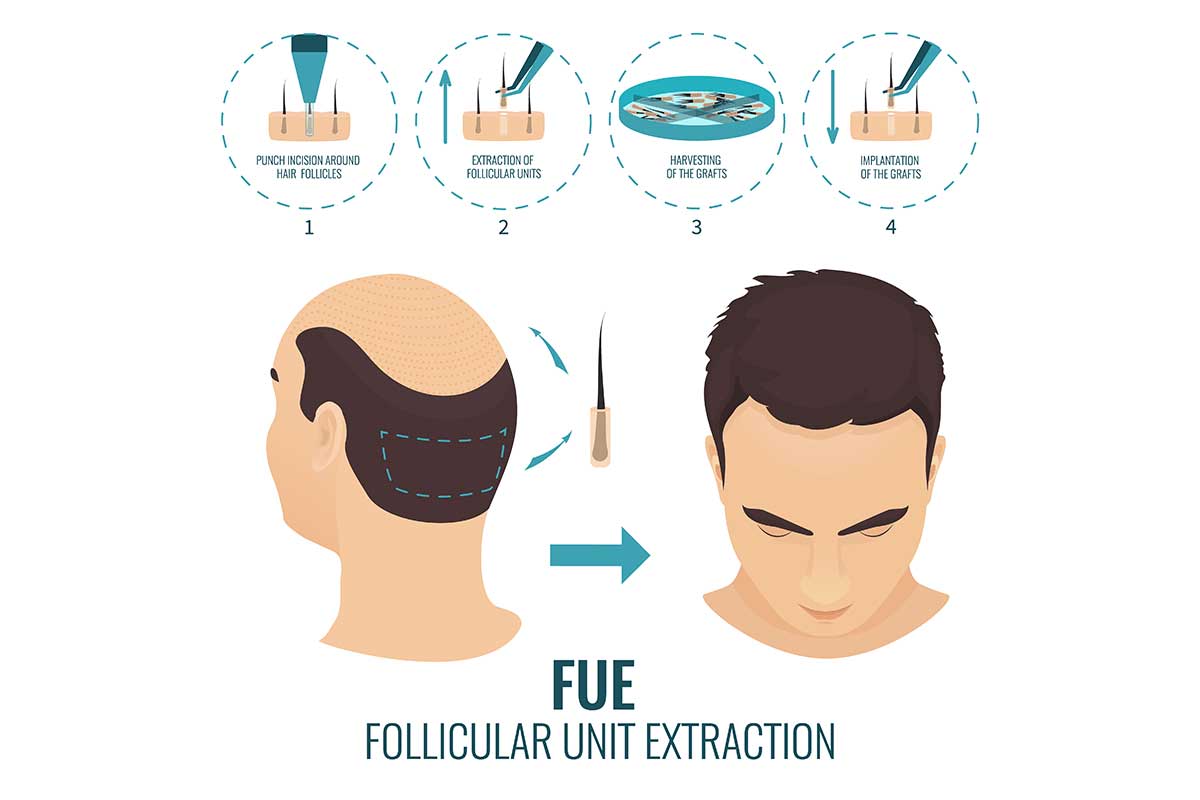 FUE hair transplant in Turkey
